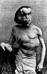 Elephant Man Joseph John Merrick